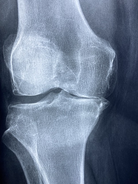 Jak zabránit infekcím a podpořit hojení koleního kloubu‍ po operaci menisku