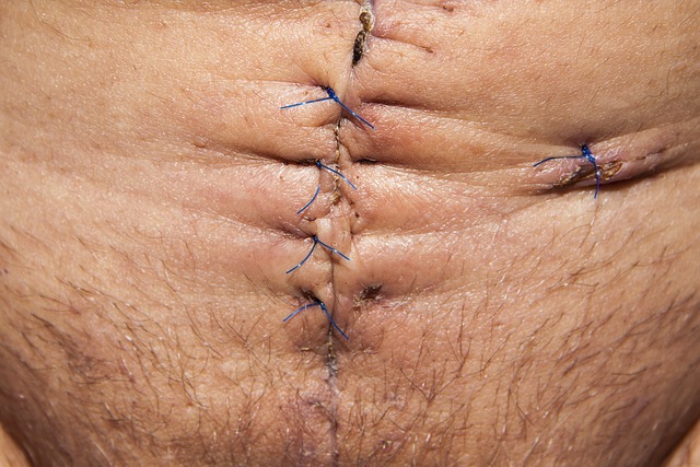 Prevence zácpy po operaci břicha: Jak minimalizovat riziko ‍střevních obtíží