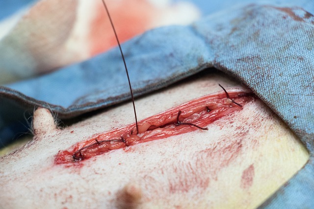 Jak se připravit na chirurgický zákrok při píštěli po operaci?