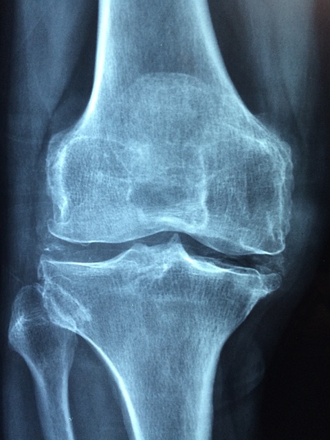 Rehabilitační program pro obnovení plné funkčnosti koleního kloubu po operaci menisku