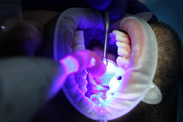 Bělení zubů s White Light: Co očekávat?